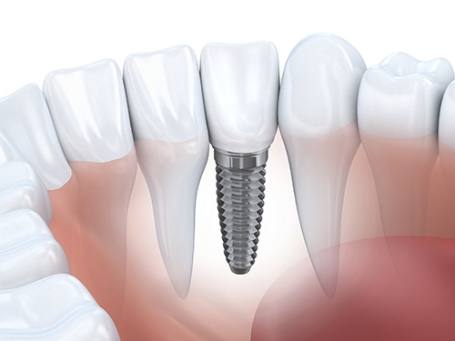 Best dental implants solutions