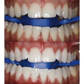 Teeth Whitening and Filling Treatment
