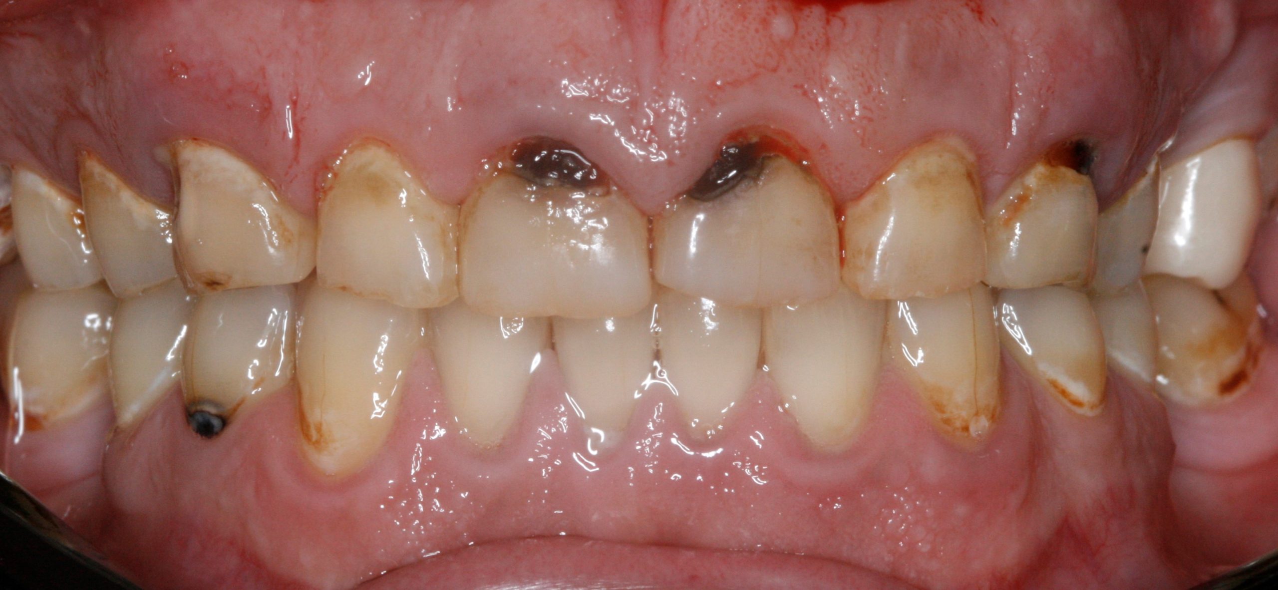 gum disease