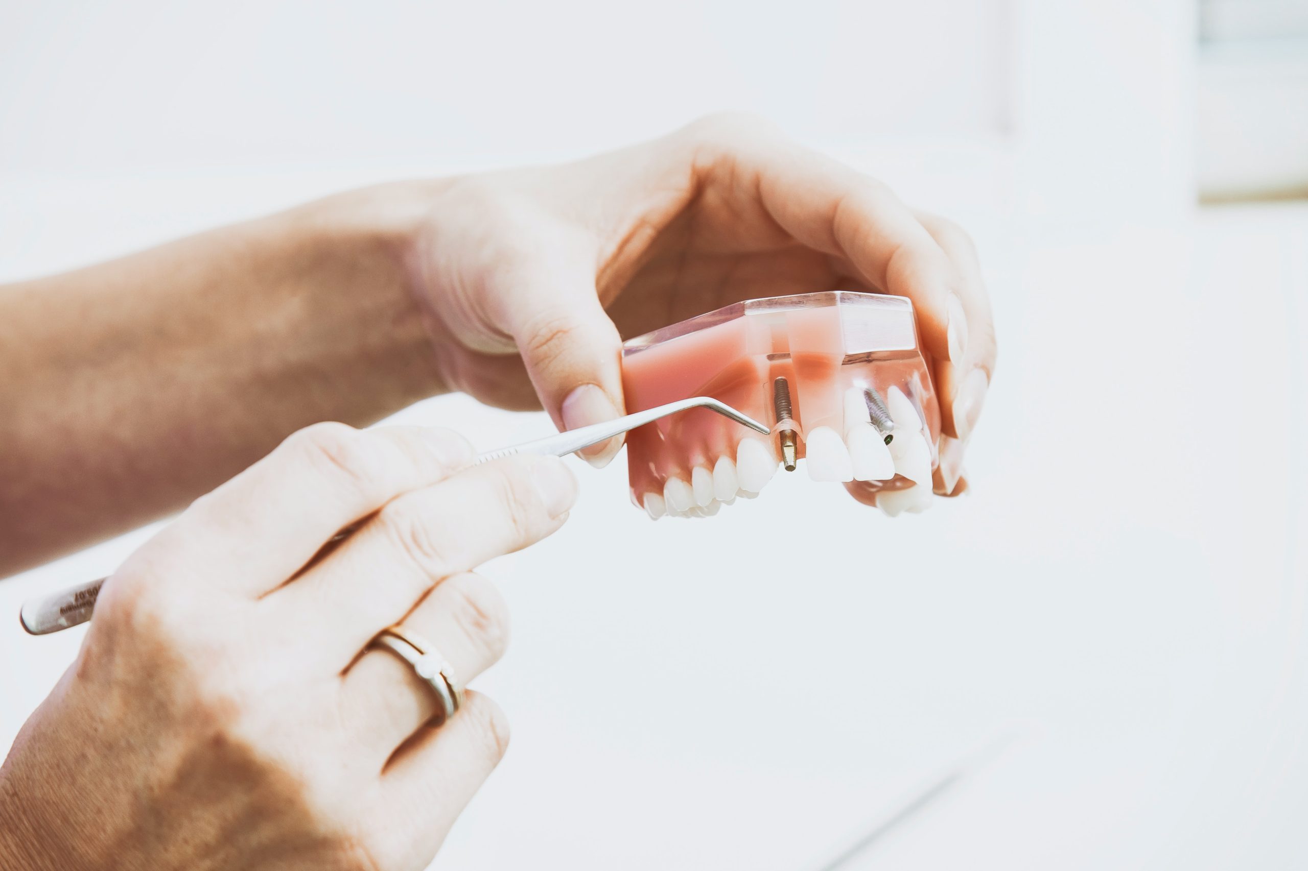 dental implants at dakabin dental