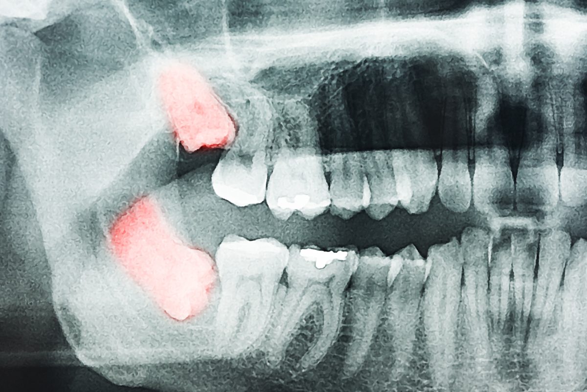 impacted-wisdom-tooth-1200x801.jpg