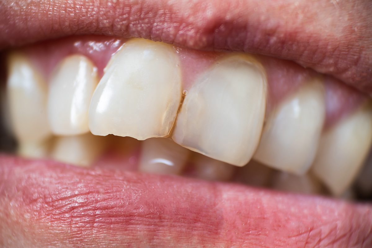 chipped-tooth-1200x800.jpg